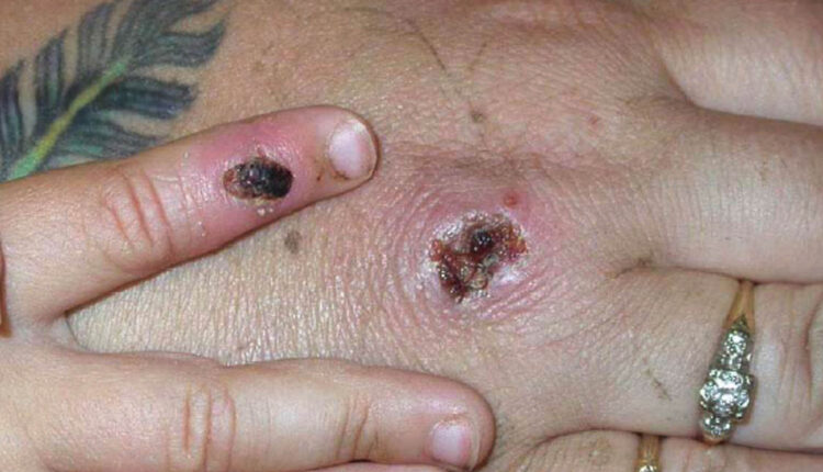 CDC expects more monkeypox cases in the U.S. ⋆ Michigan Advance
