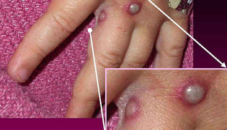 Monkeypox cases are in sharp decline. Could the outbreak be over? ⋆ Michigan Advance